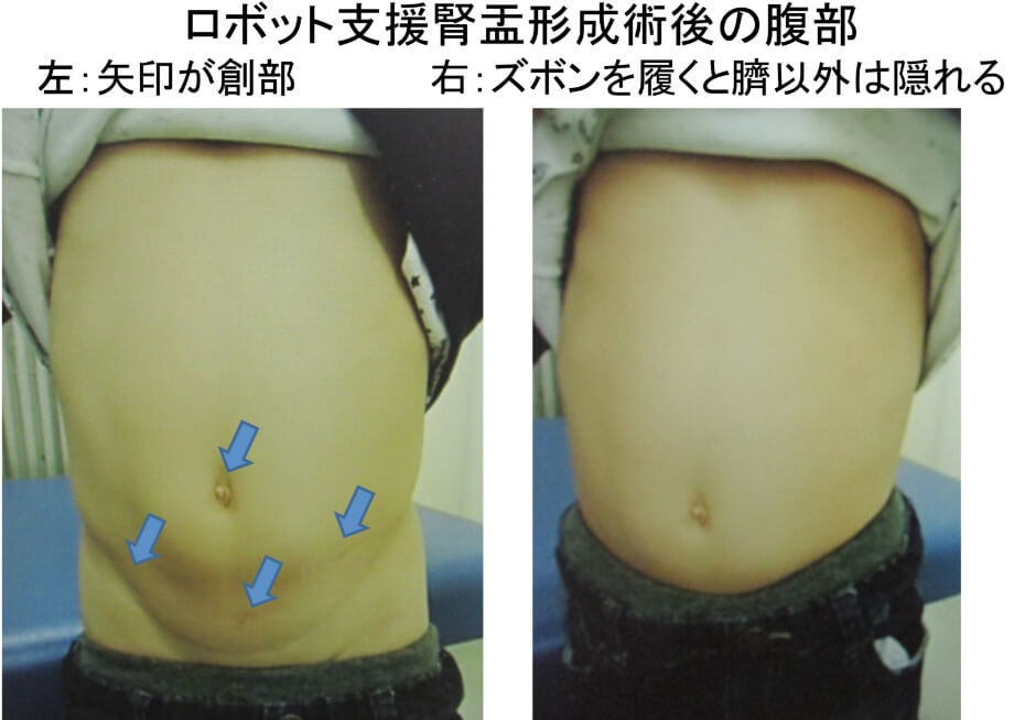 ロボット支援腎盂形成術の腹部